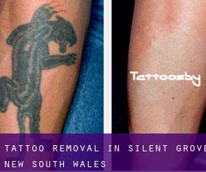 Tattoo Removal in Silent Grove (New South Wales)