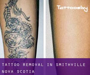 Tattoo Removal in Smithville (Nova Scotia)