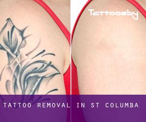Tattoo Removal in St. Columba