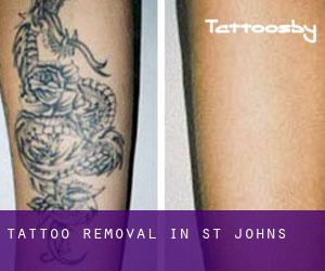 Tattoo Removal in St. John's