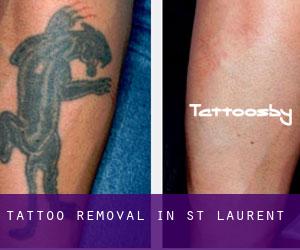 Tattoo Removal in St. Laurent
