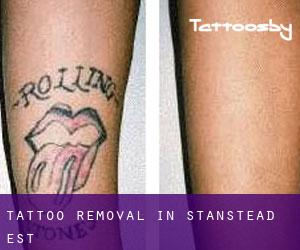 Tattoo Removal in Stanstead-Est