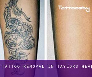 Tattoo Removal in Taylors Head