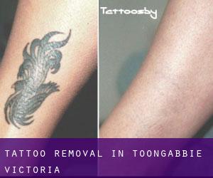 Tattoo Removal in Toongabbie (Victoria)