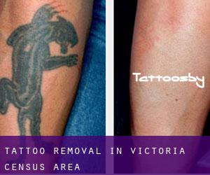 Tattoo Removal in Victoria (census area)