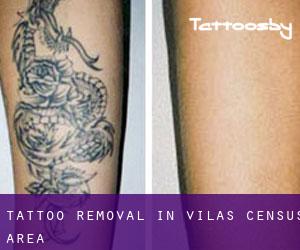 Tattoo Removal in Vilas (census area)