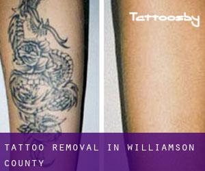 Tattoo Removal in Williamson County