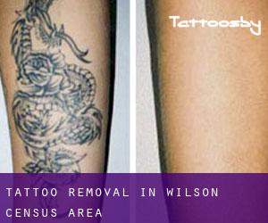 Tattoo Removal in Wilson (census area)