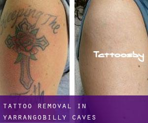 Tattoo Removal in Yarrangobilly Caves
