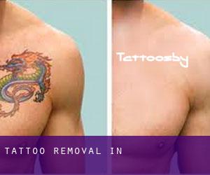 Tattoo Removal in 东海岛