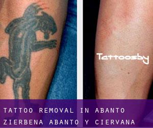 Tattoo Removal in Abanto Zierbena / Abanto y Ciérvana