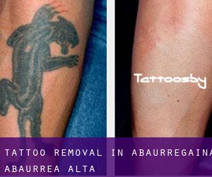Tattoo Removal in Abaurregaina / Abaurrea Alta