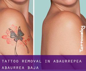 Tattoo Removal in Abaurrepea / Abaurrea Baja