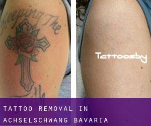 Tattoo Removal in Achselschwang (Bavaria)