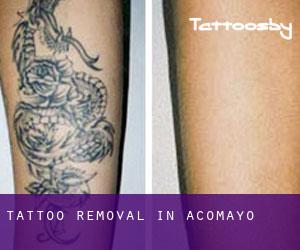 Tattoo Removal in Acomayo