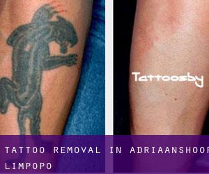 Tattoo Removal in Adriaanshoop (Limpopo)