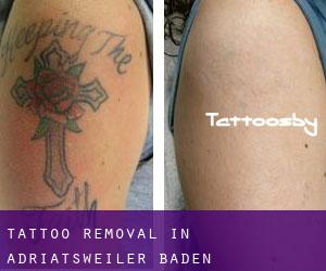 Tattoo Removal in Adriatsweiler (Baden-Württemberg)