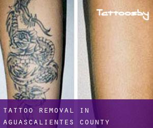 Tattoo Removal in Aguascalientes (County)