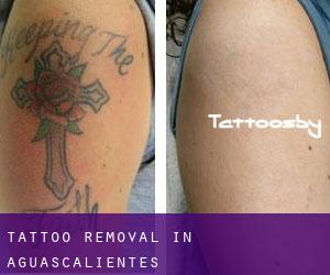 Tattoo Removal in Aguascalientes