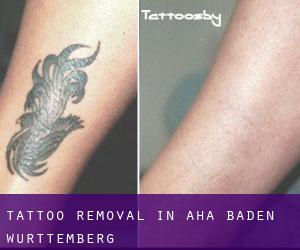 Tattoo Removal in Aha (Baden-Württemberg)