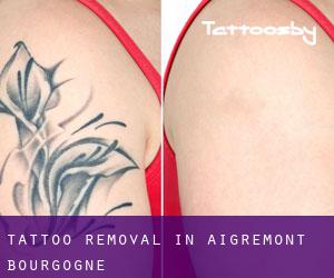 Tattoo Removal in Aigremont (Bourgogne)