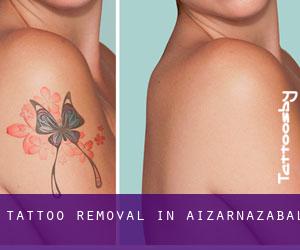 Tattoo Removal in Aizarnazabal