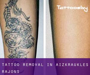 Tattoo Removal in Aizkraukles Rajons