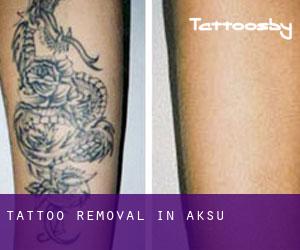 Tattoo Removal in Aksu