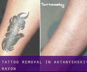 Tattoo Removal in Aktanyshskiy Rayon