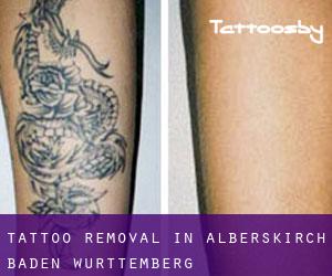 Tattoo Removal in Alberskirch (Baden-Württemberg)