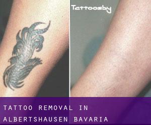 Tattoo Removal in Albertshausen (Bavaria)