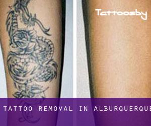 Tattoo Removal in Alburquerque