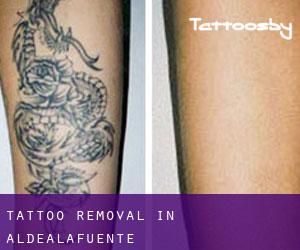 Tattoo Removal in Aldealafuente