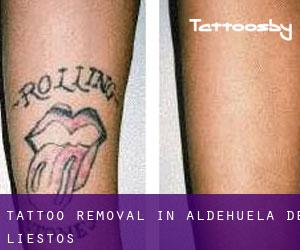 Tattoo Removal in Aldehuela de Liestos