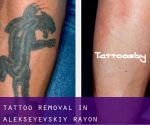 Tattoo Removal in Alekseyevskiy Rayon