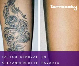 Tattoo Removal in Alexanderhütte (Bavaria)