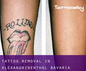 Tattoo Removal in Alexandrinenthal (Bavaria)
