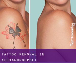 Tattoo Removal in Alexandroupoli