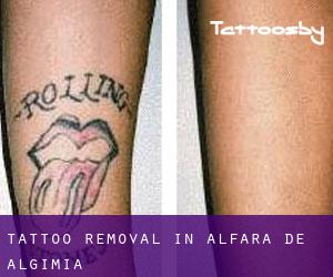 Tattoo Removal in Alfara de Algimia