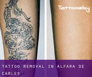 Tattoo Removal in Alfara de Carles