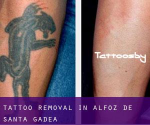 Tattoo Removal in Alfoz de Santa Gadea