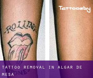 Tattoo Removal in Algar de Mesa