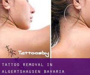 Tattoo Removal in Algertshausen (Bavaria)