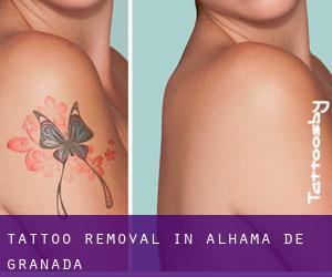 Tattoo Removal in Alhama de Granada