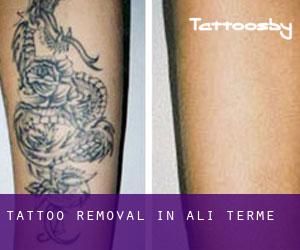 Tattoo Removal in Alì Terme