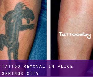 Tattoo Removal in Alice Springs (City)