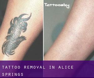 Tattoo Removal in Alice Springs