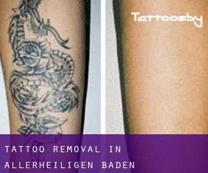 Tattoo Removal in Allerheiligen (Baden-Württemberg)