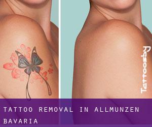 Tattoo Removal in Allmunzen (Bavaria)