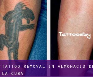 Tattoo Removal in Almonacid de la Cuba